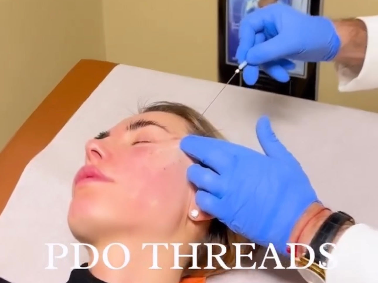 PDO Threads (NON-SURGICAL FACE LIFT)
