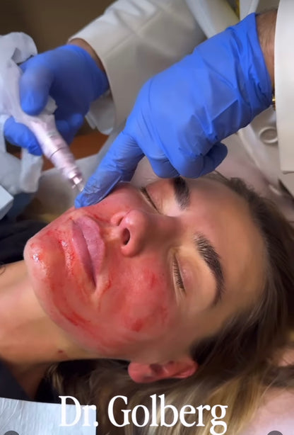 Vampire Facial with Exosomes